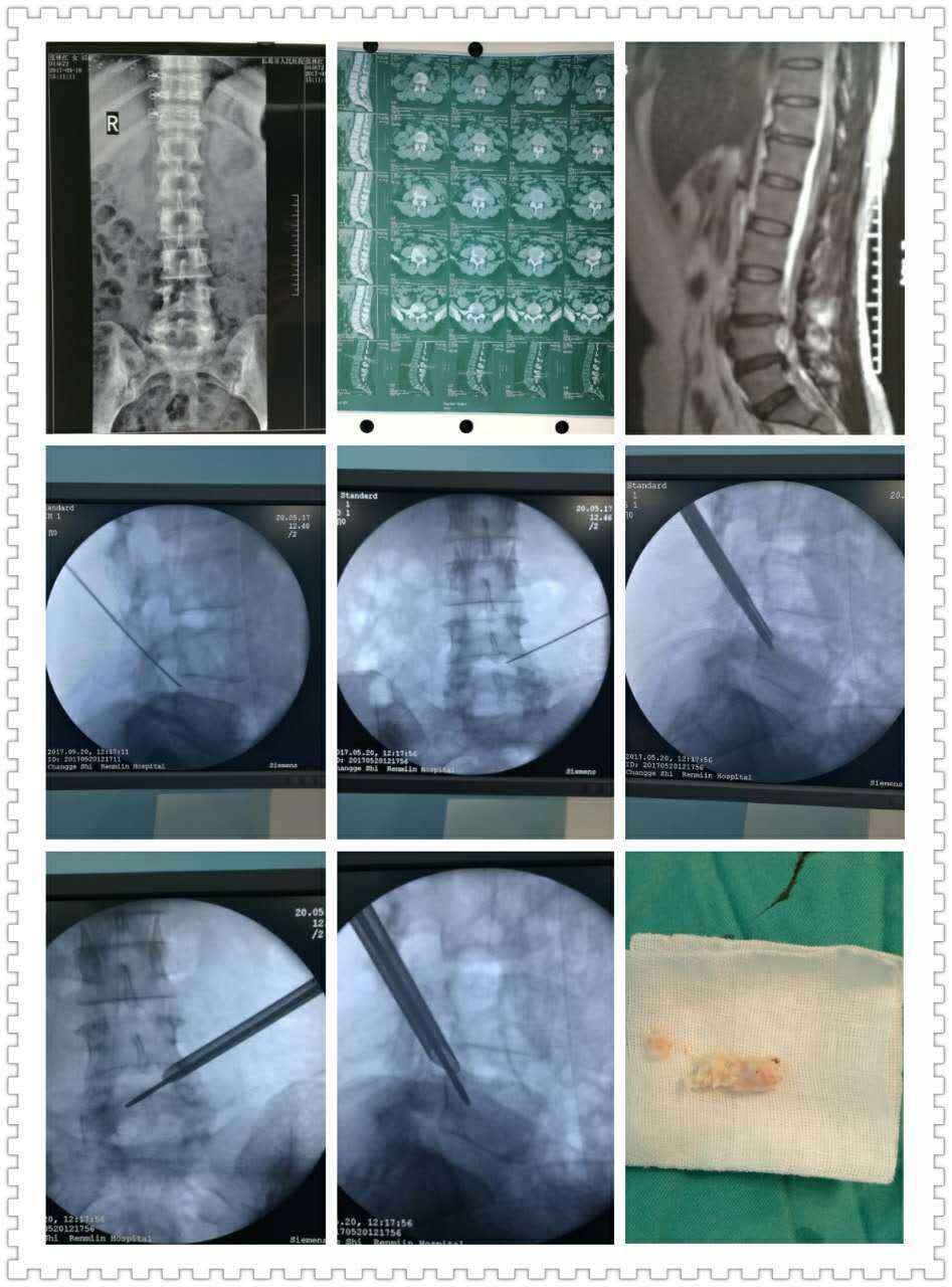 腰椎间盘突出症-移行椎