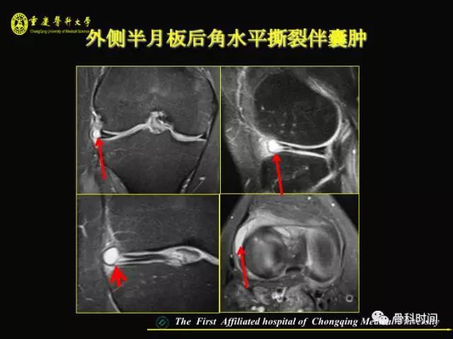 半月板 膝关节半月板mri 入门 看这篇就够了