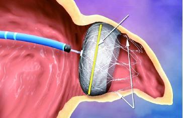 房颤左心耳封堵术简介