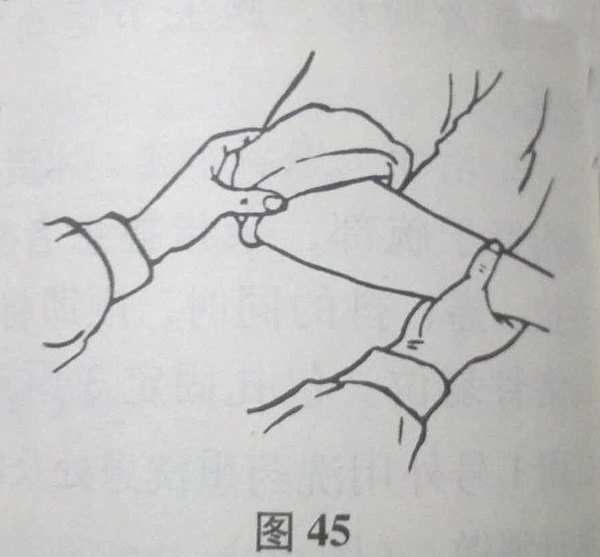 前(或旋后),拇指稍用力按压桡骨小头,听到或感到一声响即示复位(图45)