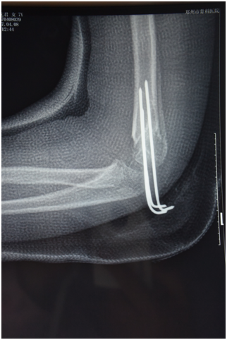 儿童肱骨髁上骨折闭合复位钢针内固定手术治疗典型病例 