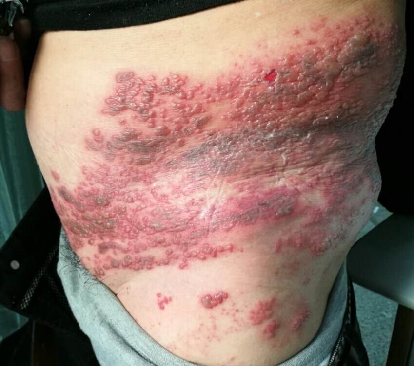 五、带状疱疹的药物治疗