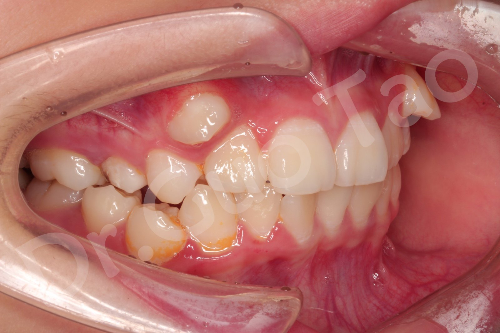 口内右侧照片,帮助医生判断右侧牙齿的错位情况以及咬合关系