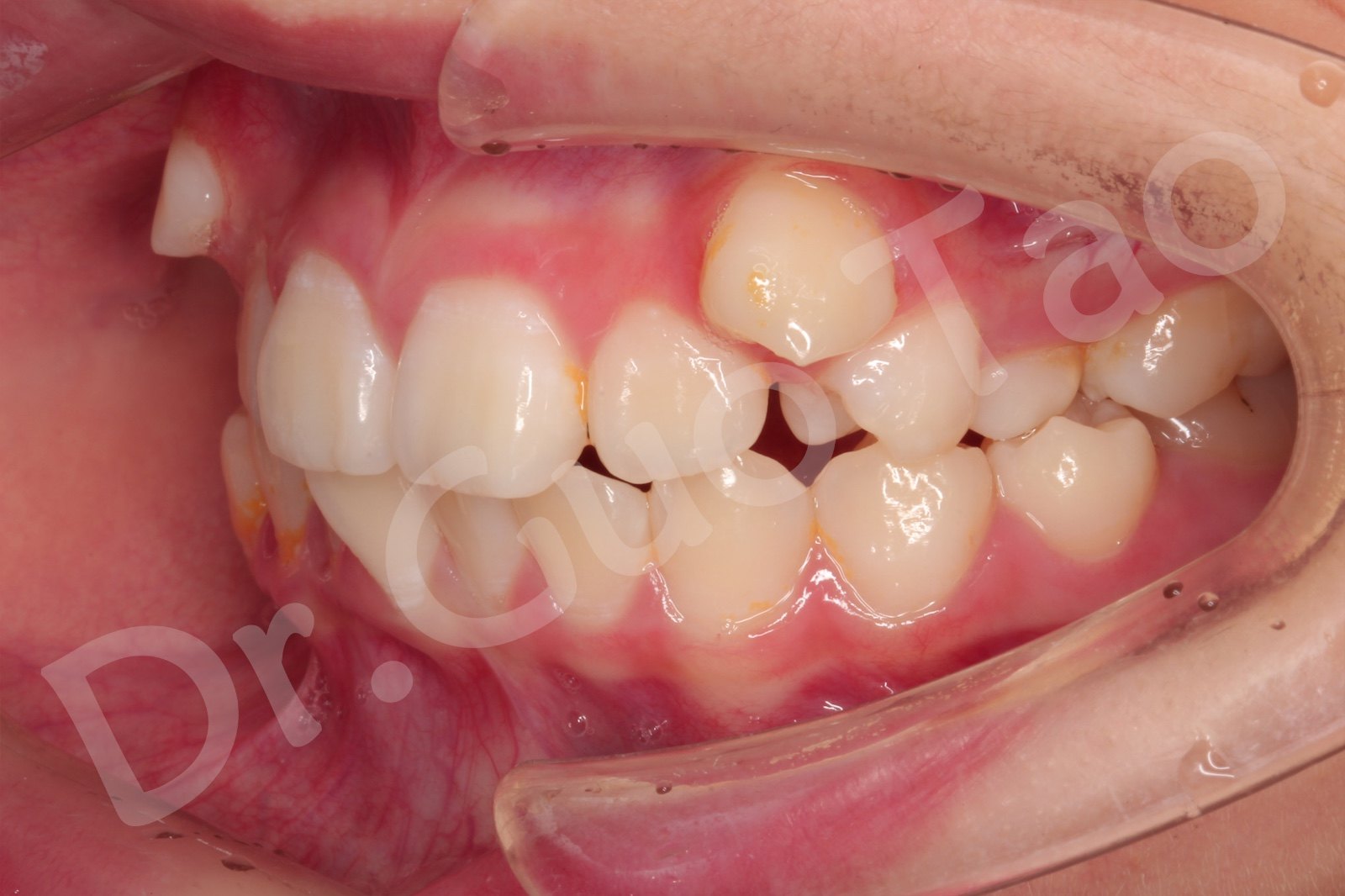 口内左侧照片,帮助医生判断左侧牙齿的错位情况以及咬合关系