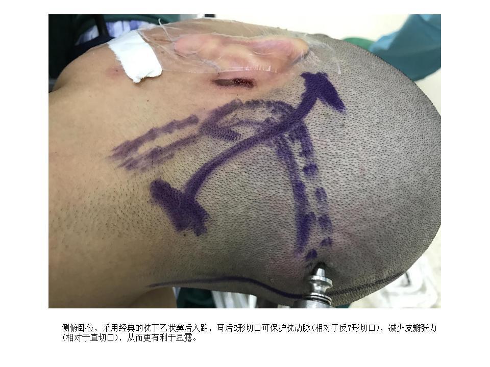 微创手术切除颅底(桥小脑角区)巨大脑膜瘤 - 好大夫在线