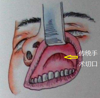 鼻前庭囊肿位置图图片