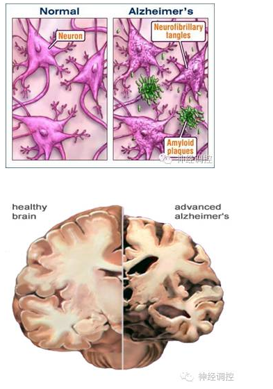脑深部电刺激穹窿(DBS-f)治疗阿尔茨海默病的