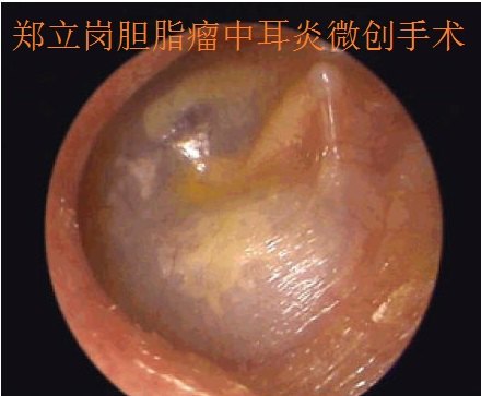 膽脂瘤中耳炎耳內鏡微創手術第453廣東佛山順德蘇