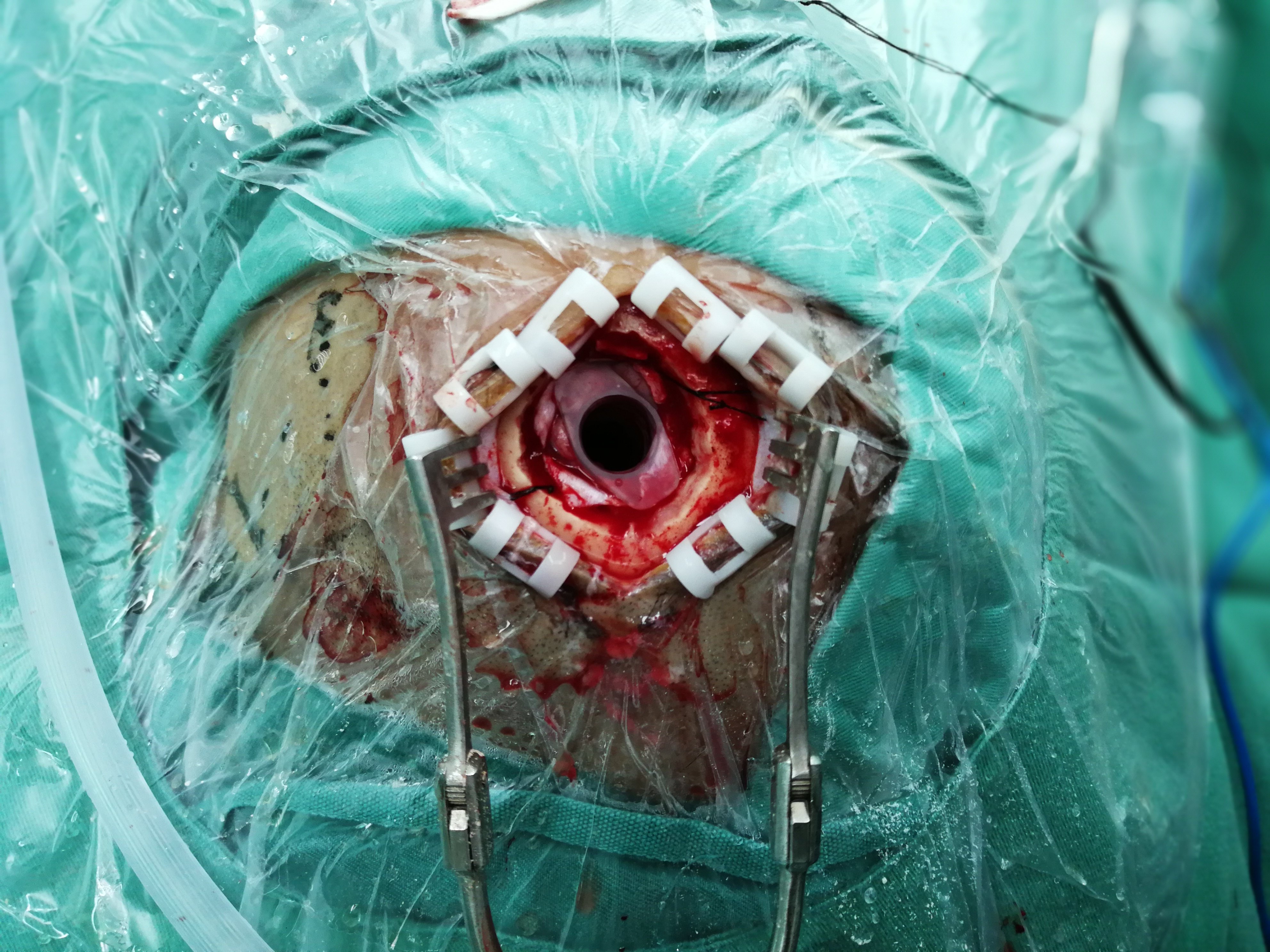 神经内镜下脑出血清除术 - 好大夫在线