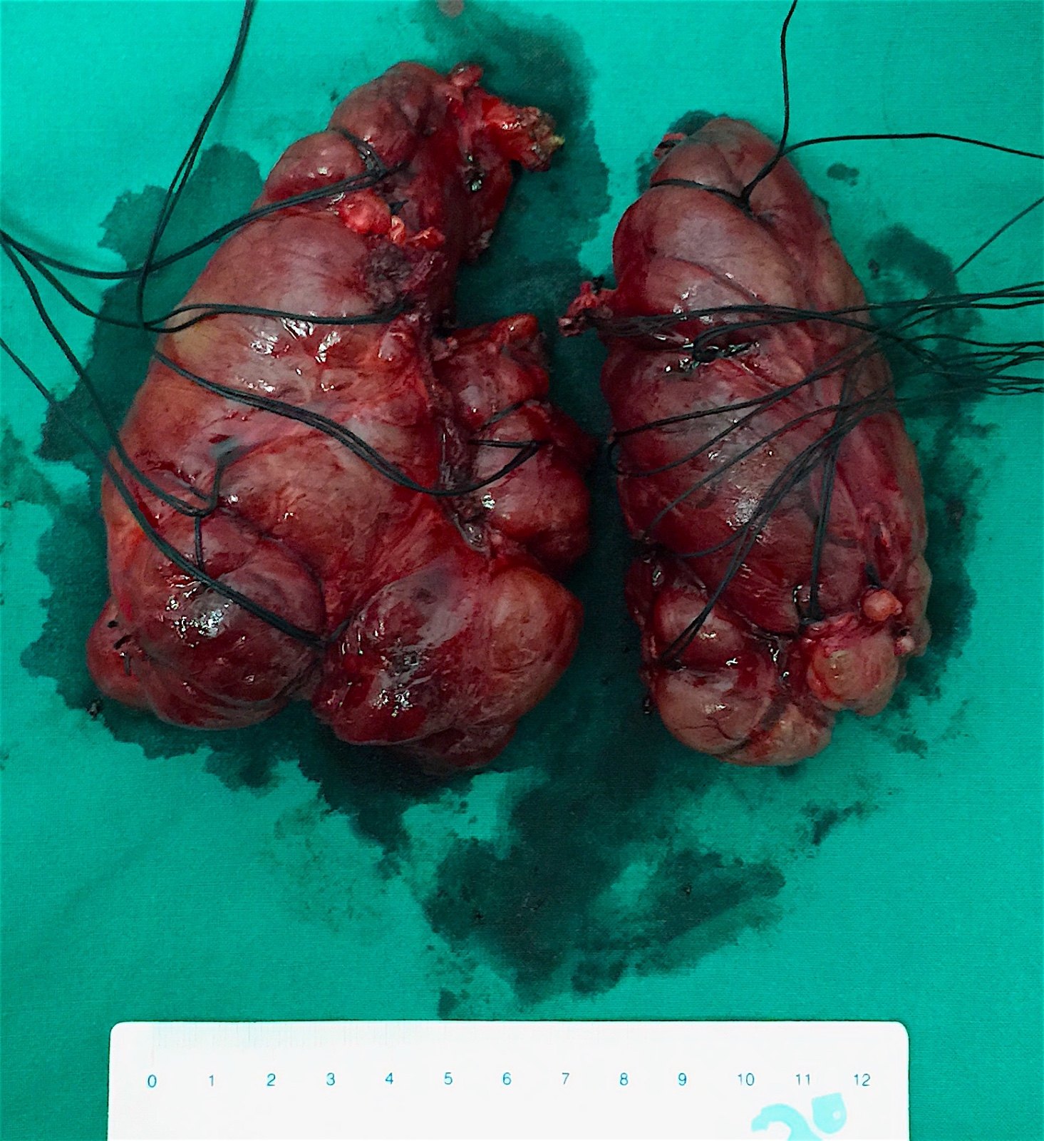 对付甲亢有三招