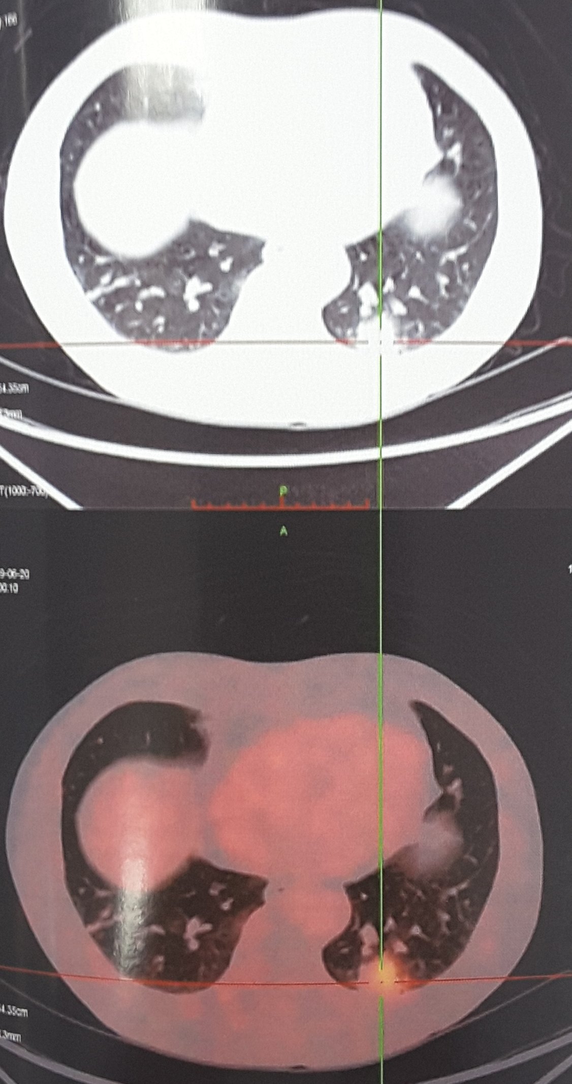 petct肺癌图片