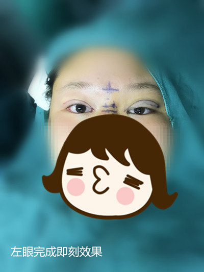 微创双眼皮手术术后不红不肿美丽蜕变图集