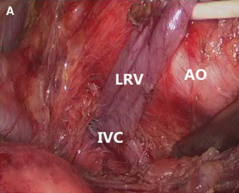 浅谈胡桃夹综合征的原因及诊疗