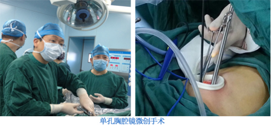 心脏搭桥手术新技术助力心脏病患者重启新生活