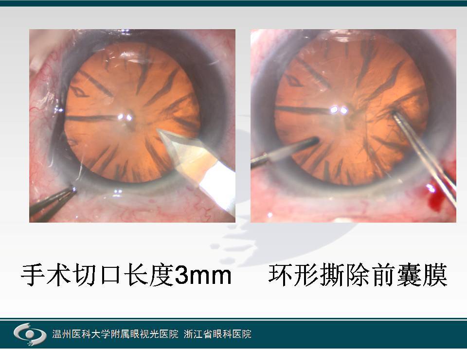 超声乳化白内障手术是这样做的