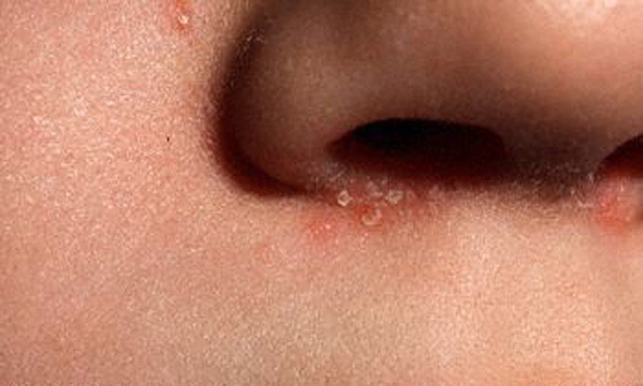 面部脂溢性皮炎可累及前额,鼻唇沟,面颊,眉部及眉间等皮脂溢出部位