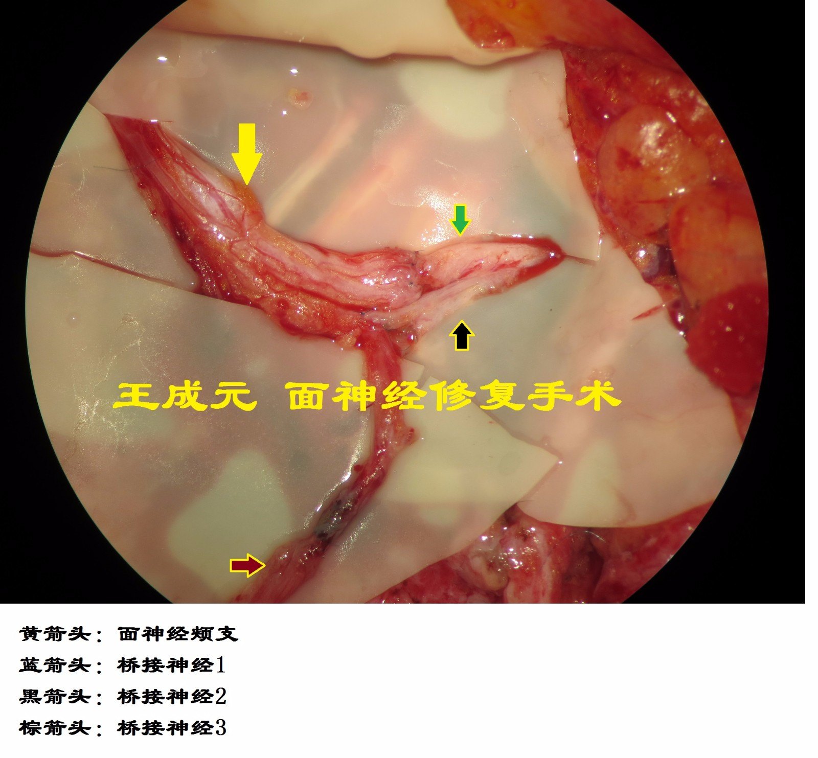 面神经断裂导致外伤性面瘫的手术治疗