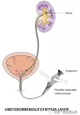 输尿管软镜结构图片