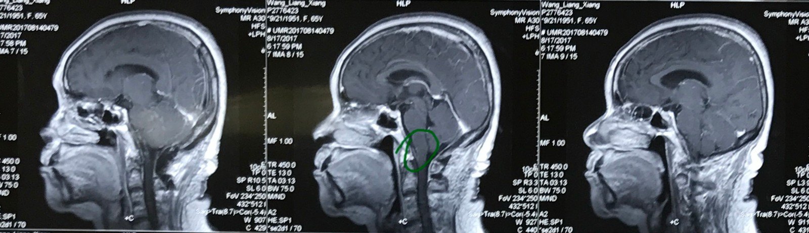 枕下遠外側入路枕骨大孔區延髓腹側腦膜瘤全切除一例