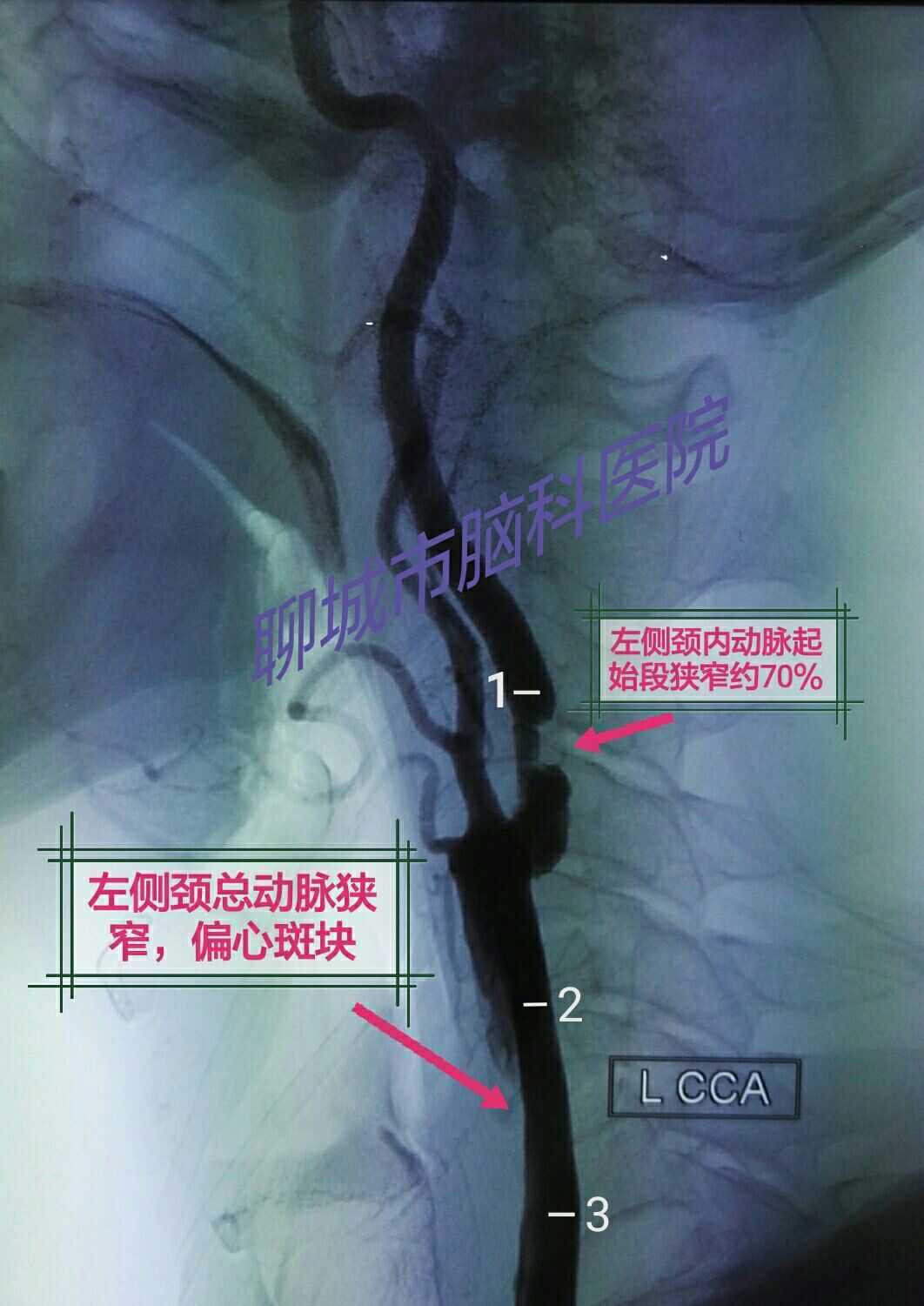 雙側頸動脈內膜剝脫術一例