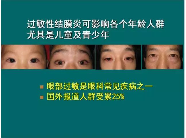 过敏性结膜炎的治疗 (ppt) - 好大夫在线