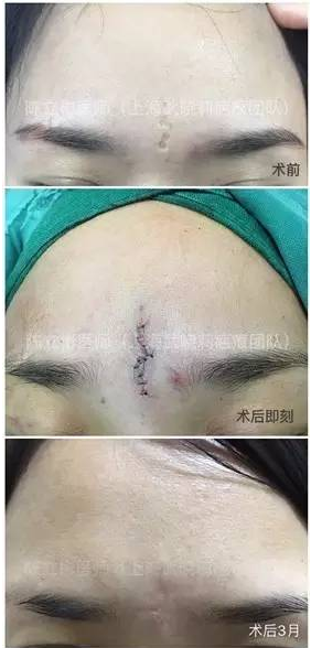 陈立彬疤痕讲堂(一):改形手术