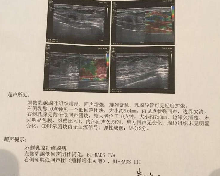 分叶状乳腺结节图片