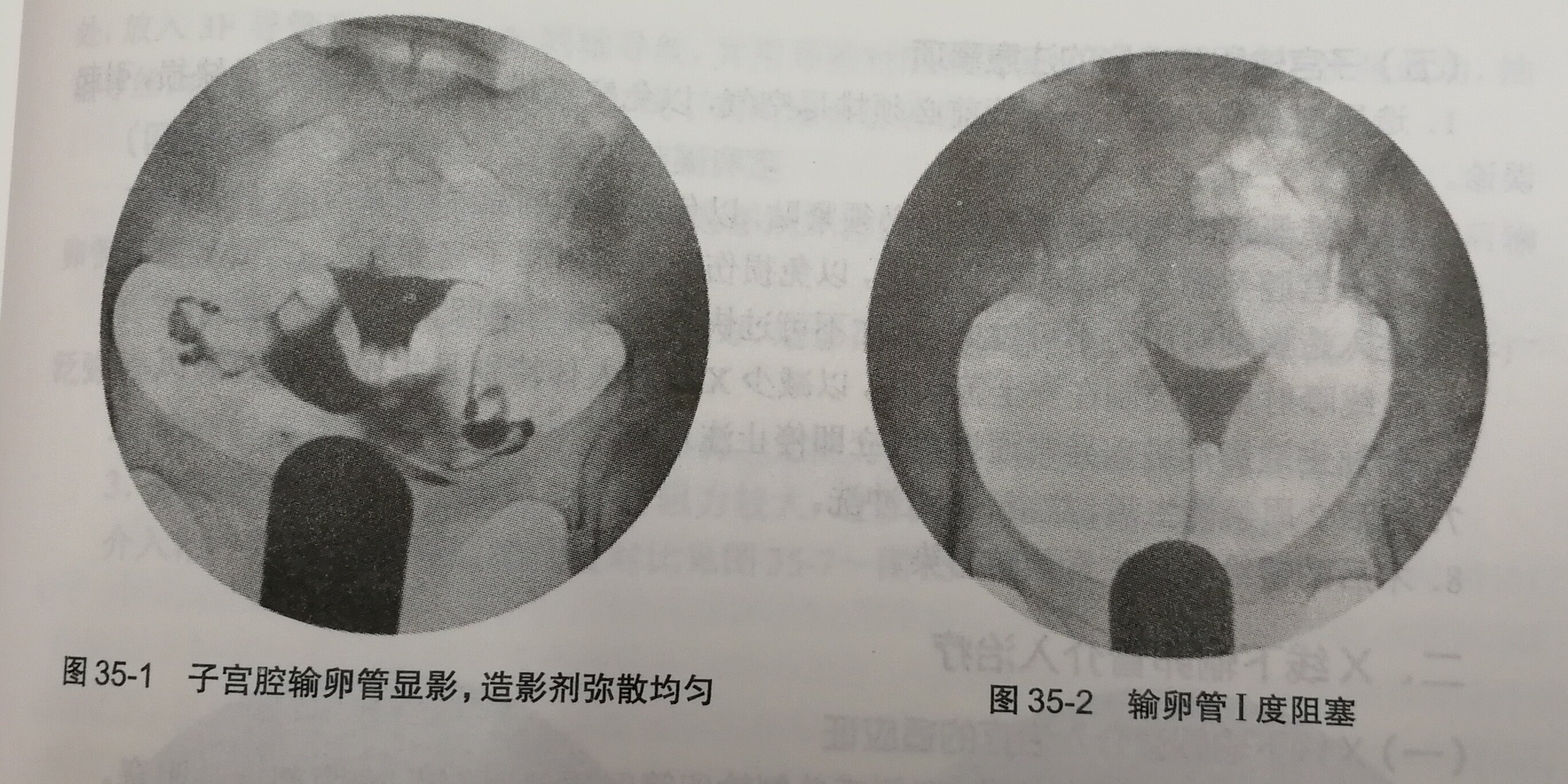 子宮輸卵管造影結果評定