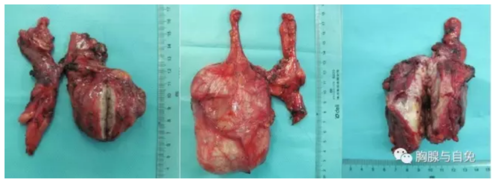 胸腺瘤照片图片