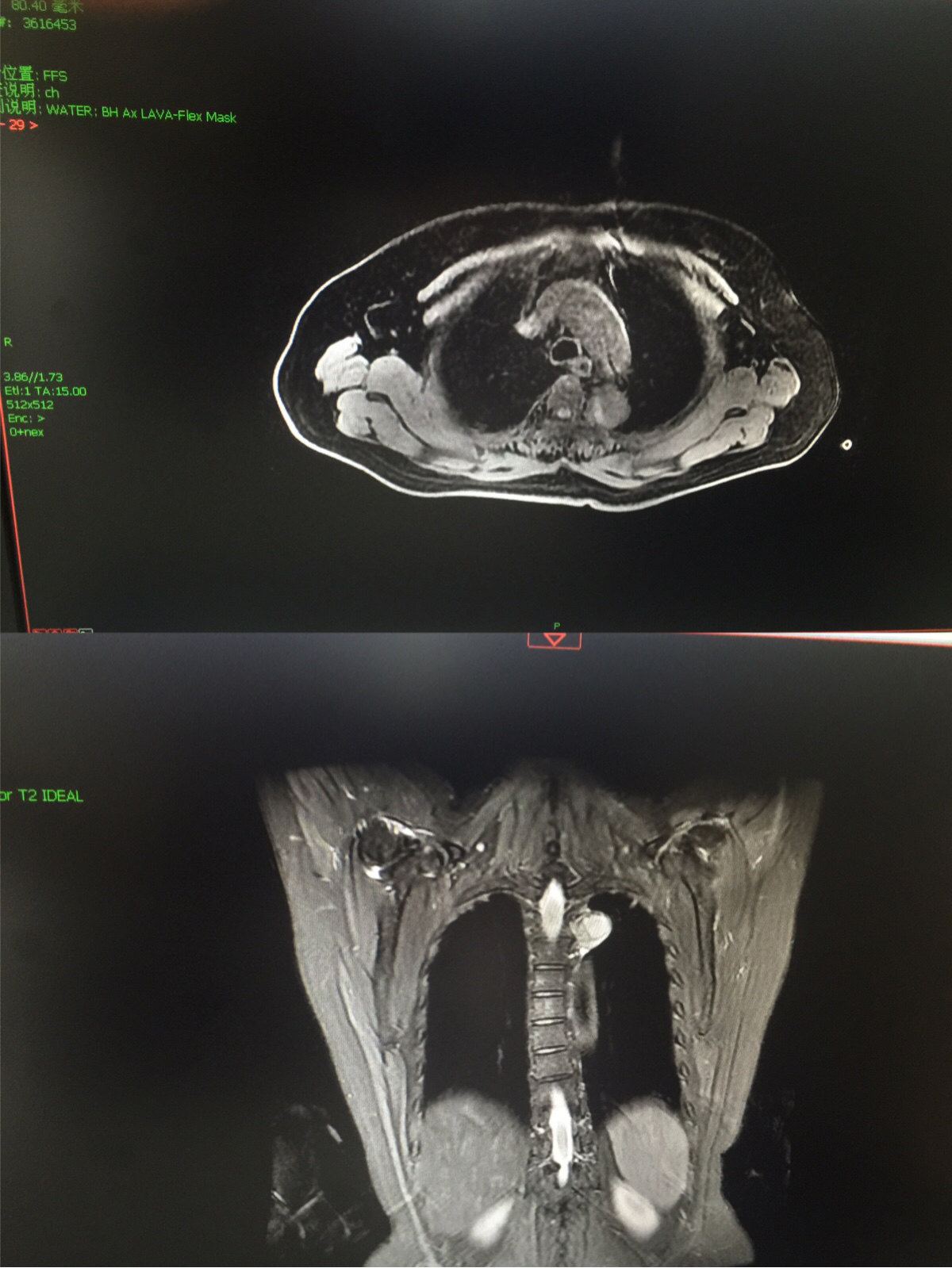 难治疗的纵隔神经源性肿瘤