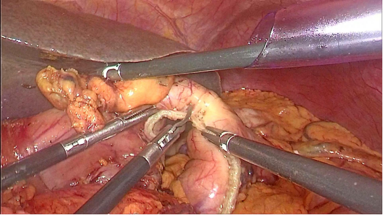横断远端胃3,显露肠系膜上静脉2,打开网膜囊,显露胰腺1,戳卡布局手术