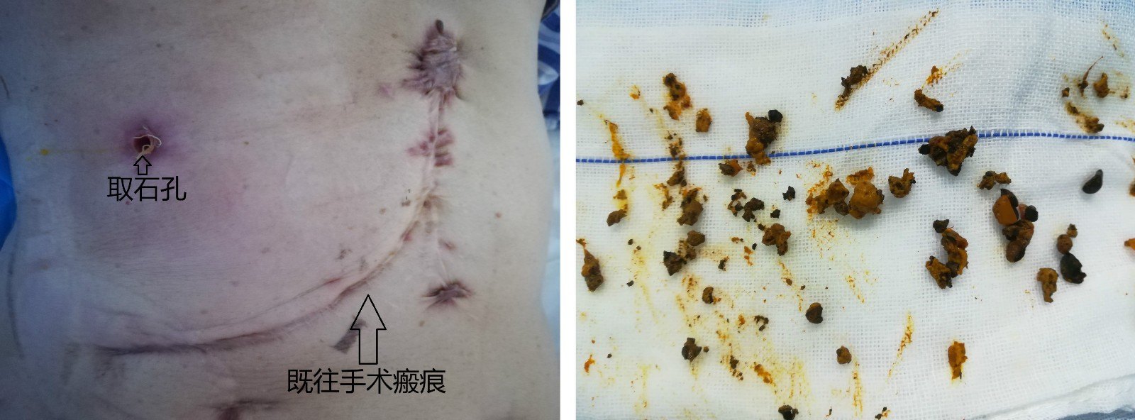 图3患者此次手术和既往手术切口对比(左),患者体内取出的肝内胆管结石