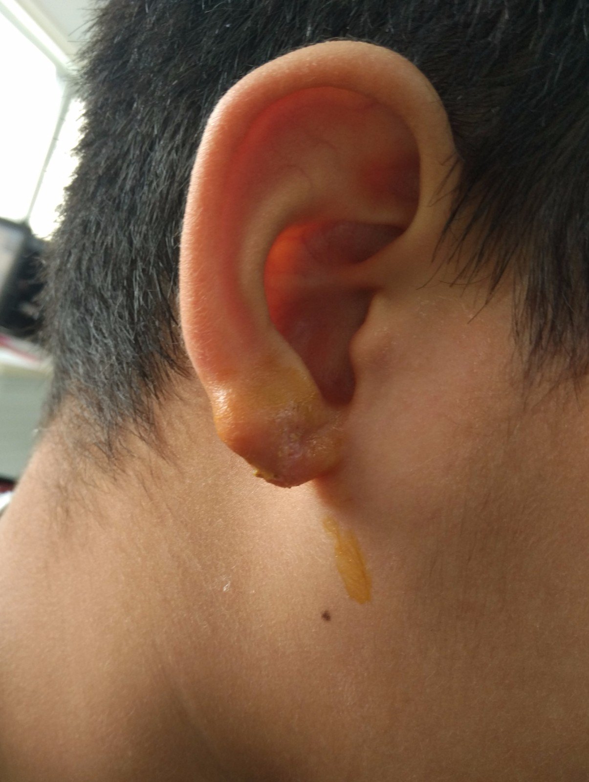 耳垂裂的手术治疗
