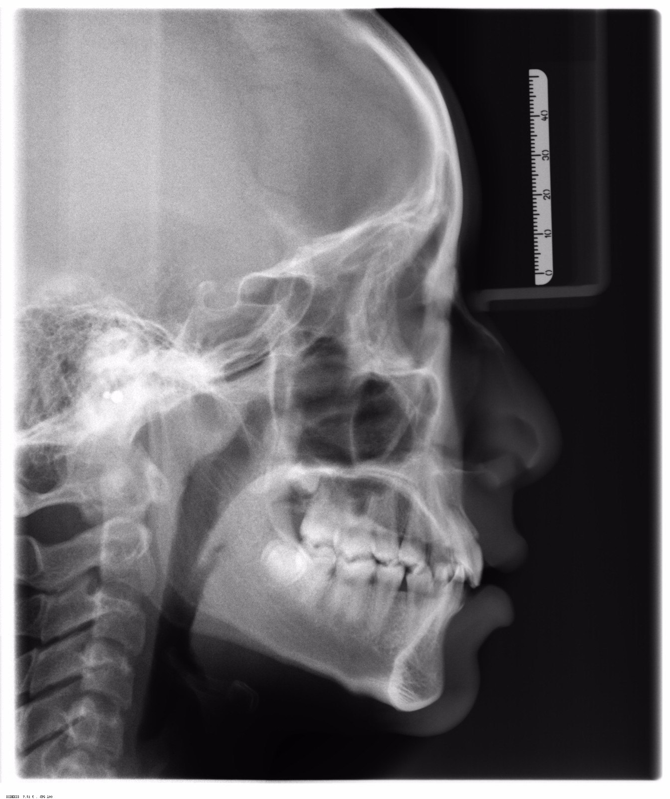 矫正牙齿为什么要拍片子? - 好大夫在线