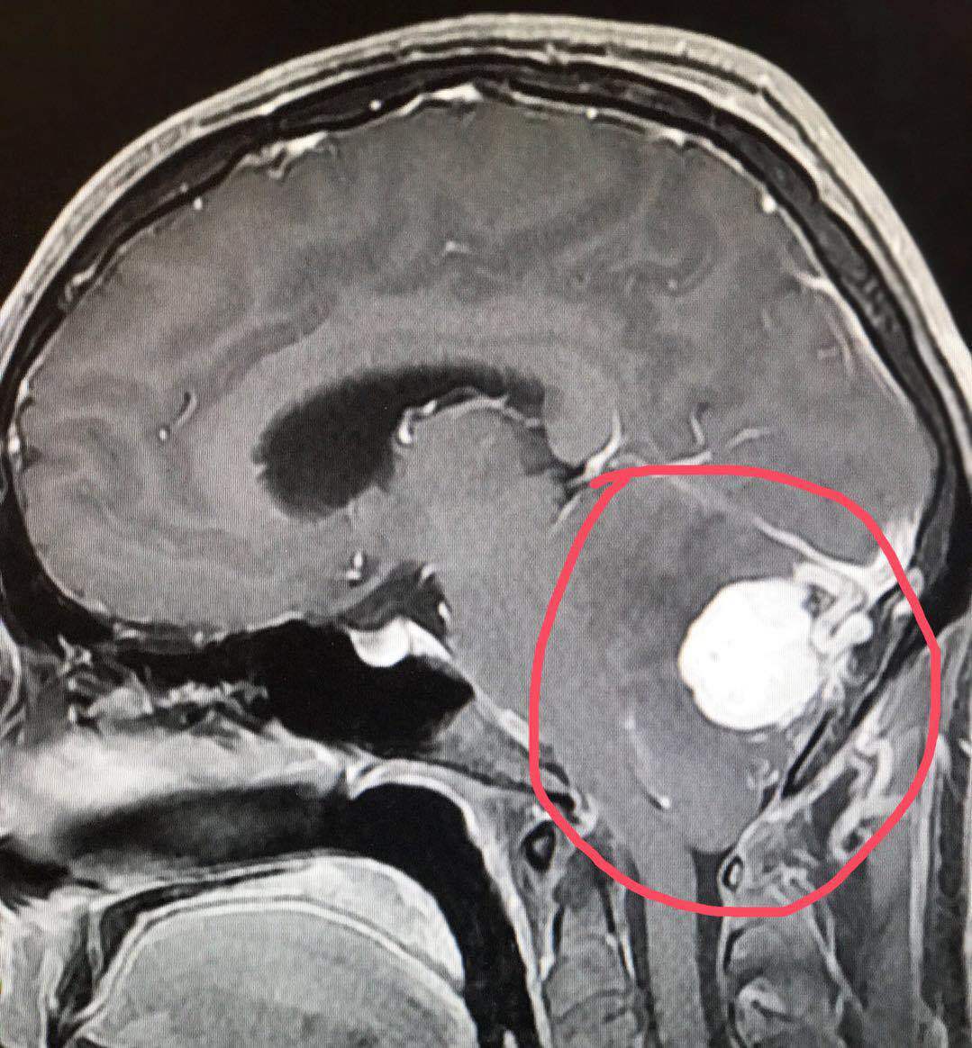 haodf:8:xueguanwangzhuangxibaoliu-->血管母细胞瘤 !