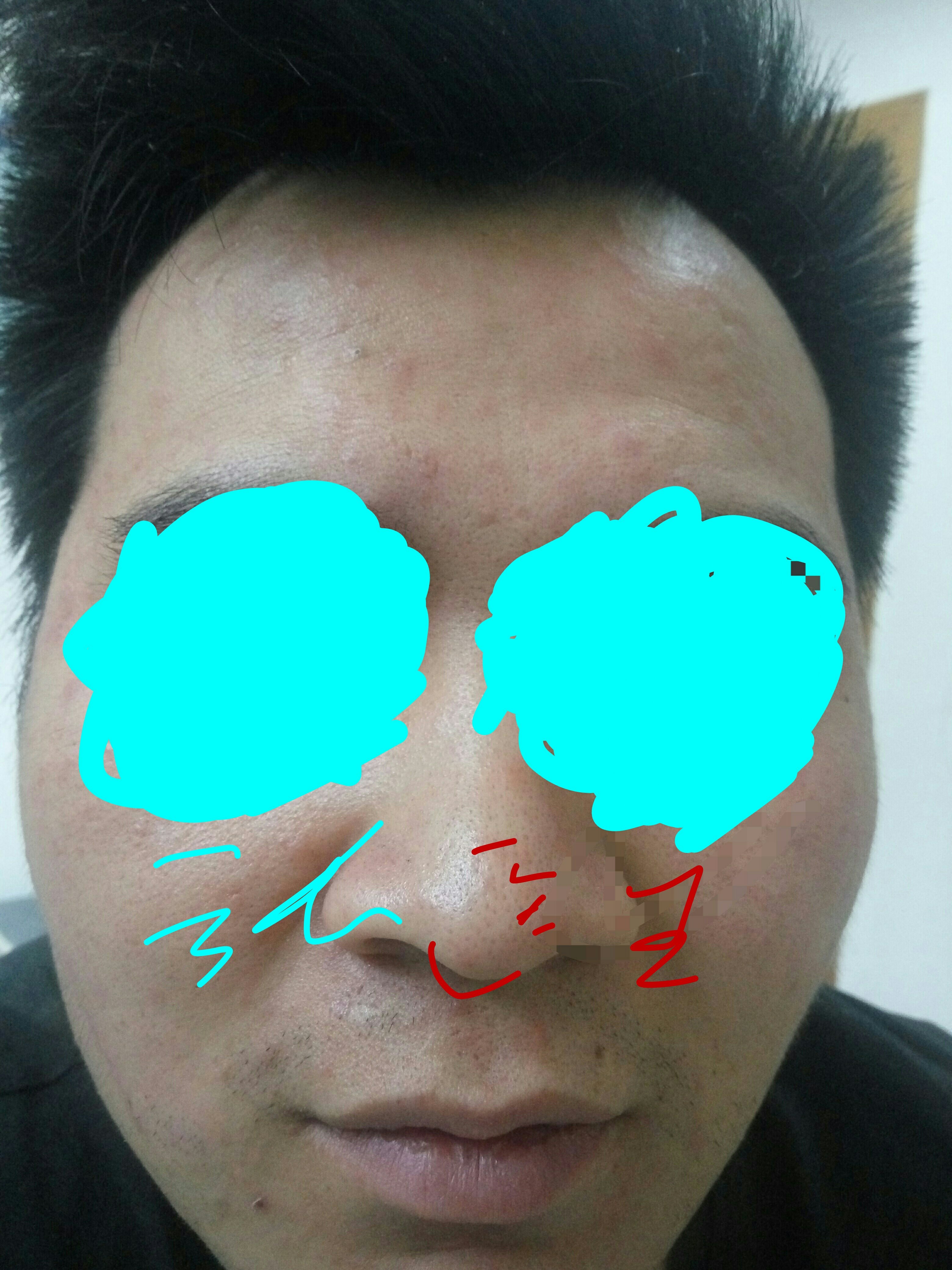 过敏性皮炎和水痘诊断思路的思考