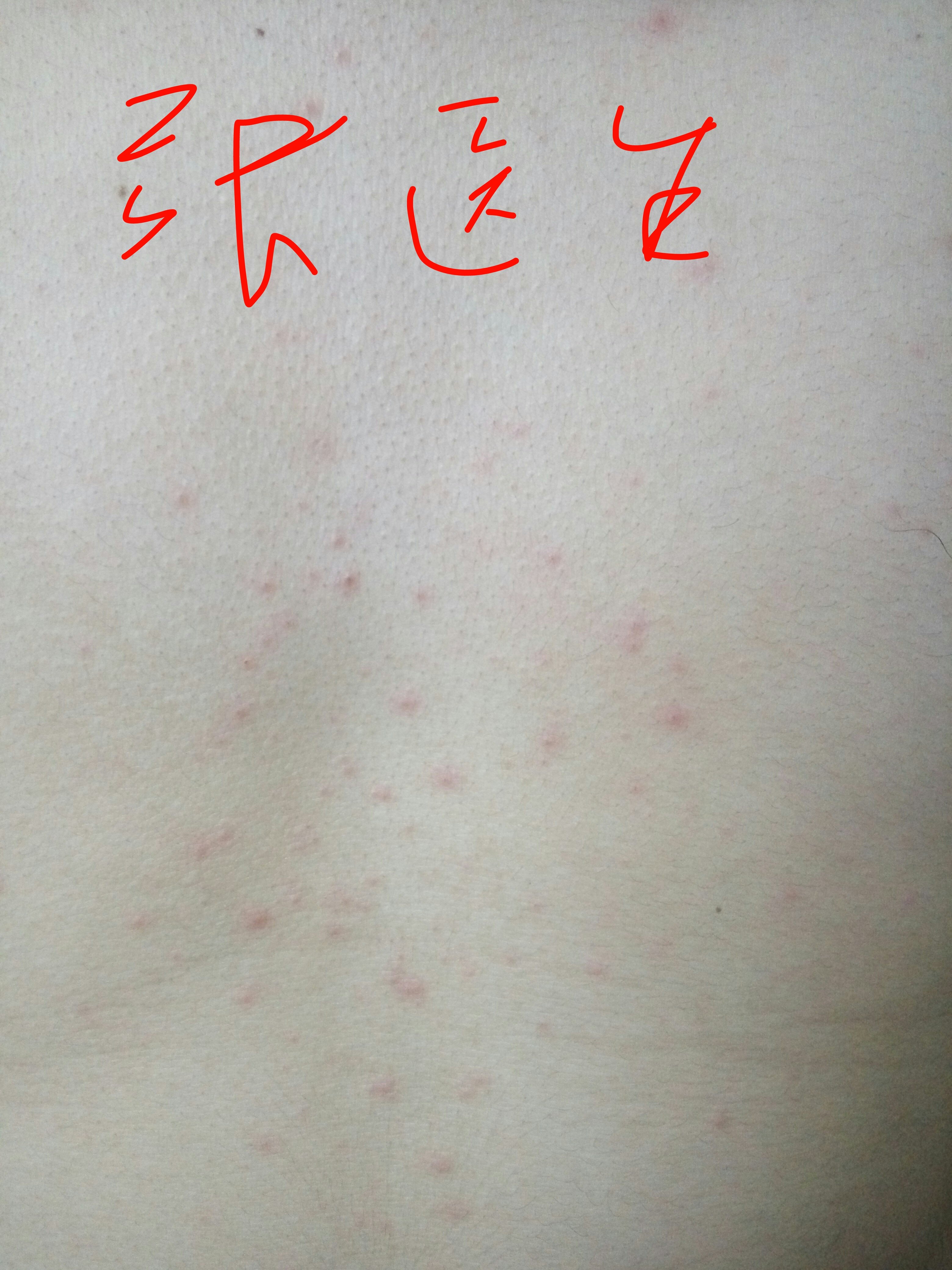 过敏性皮炎和水痘诊断思路的思考 - 好大夫在线