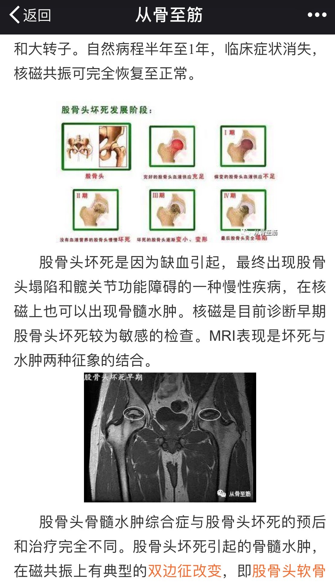 股骨头骨髓水肿就一定是坏死吗?(转载) - 好大夫在线