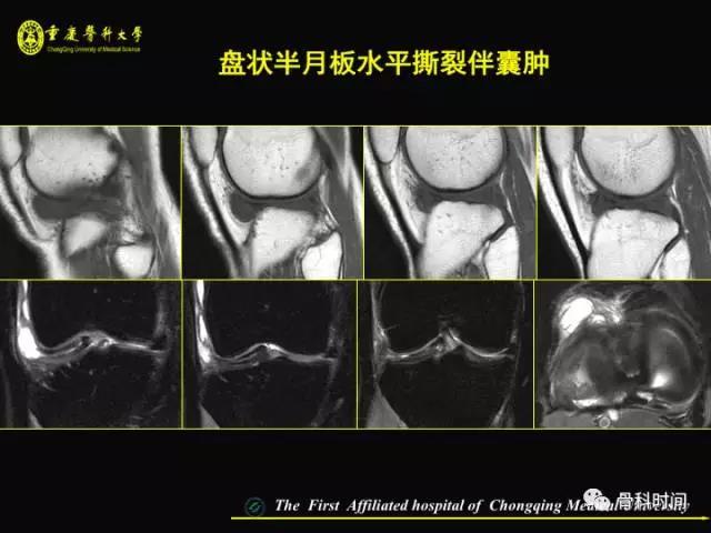 半月板 膝关节半月板mri 入门 看这篇就够了