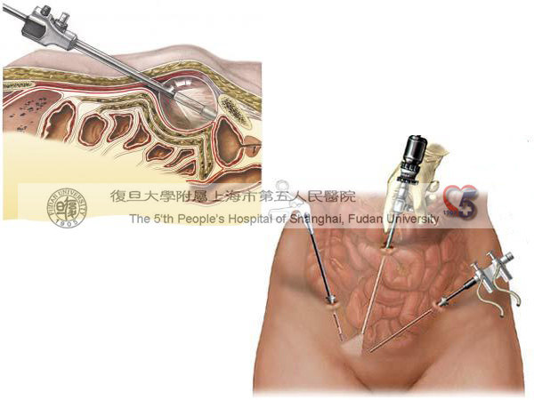 tapp和tep都可以做到将补片与牢固的结构组织固定,同时覆盖斜疝内口