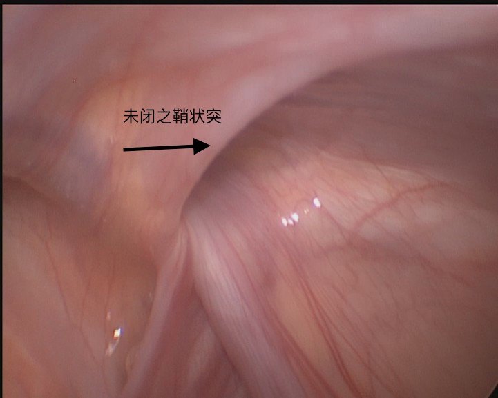 小儿腹股沟斜疝与鞘膜积液