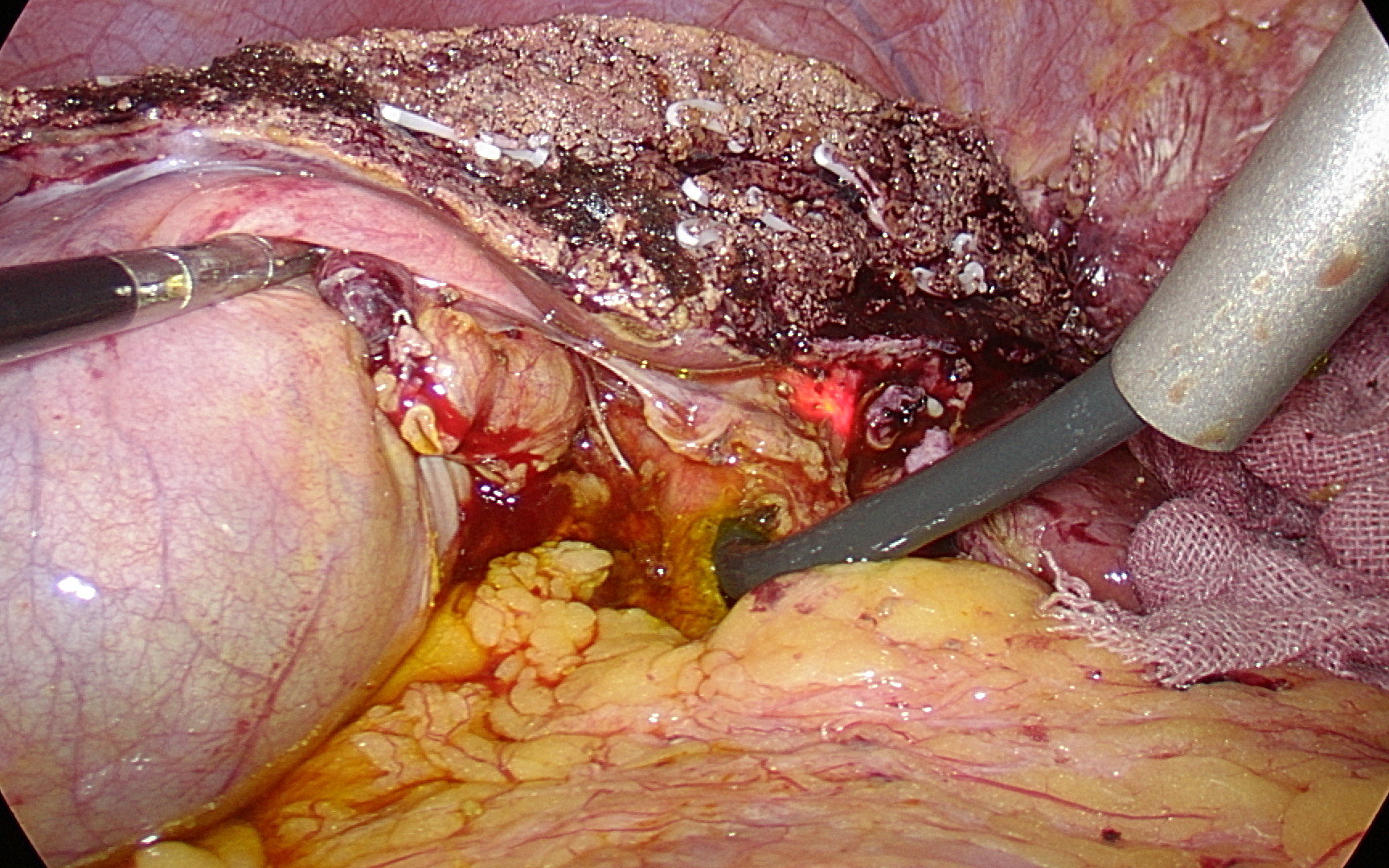 肝右叶胆管结石图片