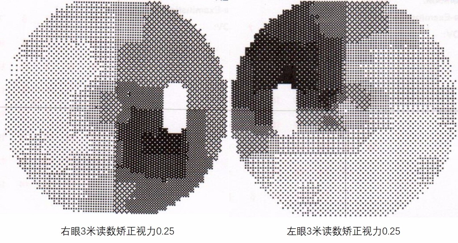 视力视野检查示:双颞侧视野缺损.