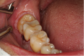 如果智齿和前面邻牙之间有 食物嵌塞,也要重视起来