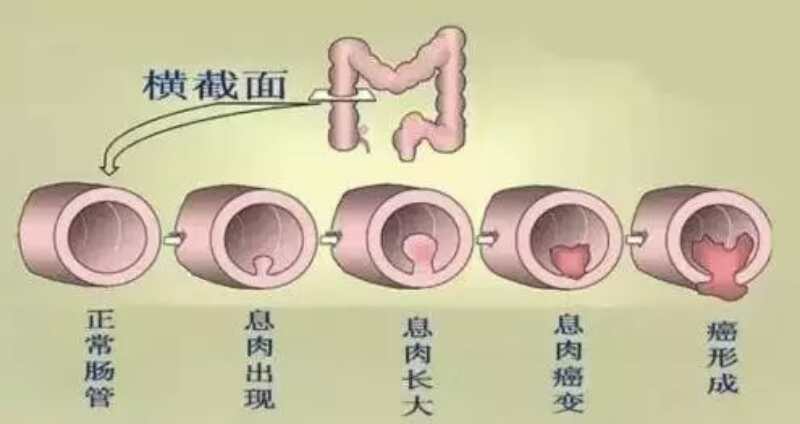 直肠息肉演变为直肠癌过程示意图曲周县中医院(北区)肛肠科常年开展直