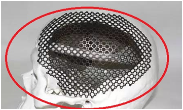 peek(聚醚醚酮)-----颅骨修补材料的选择 - 好大夫在线