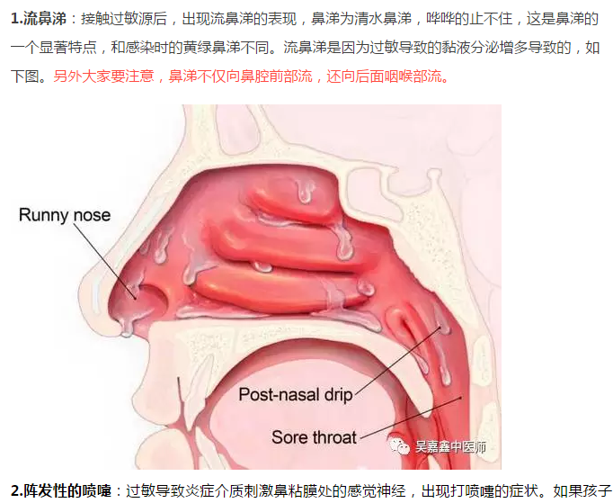 鼻炎示意图图片