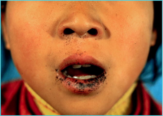 syndrome二,peutz-jeghers syndrome(色素沉着-息肉综合征)又称口周