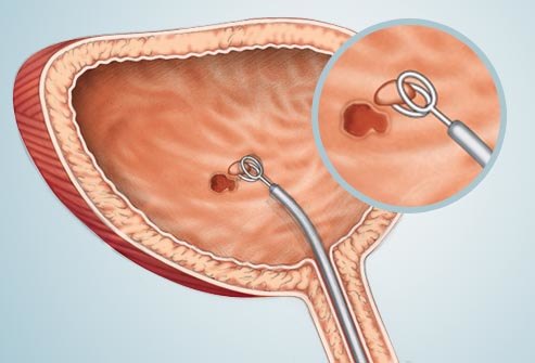聊聊膀胱癌那些事儿