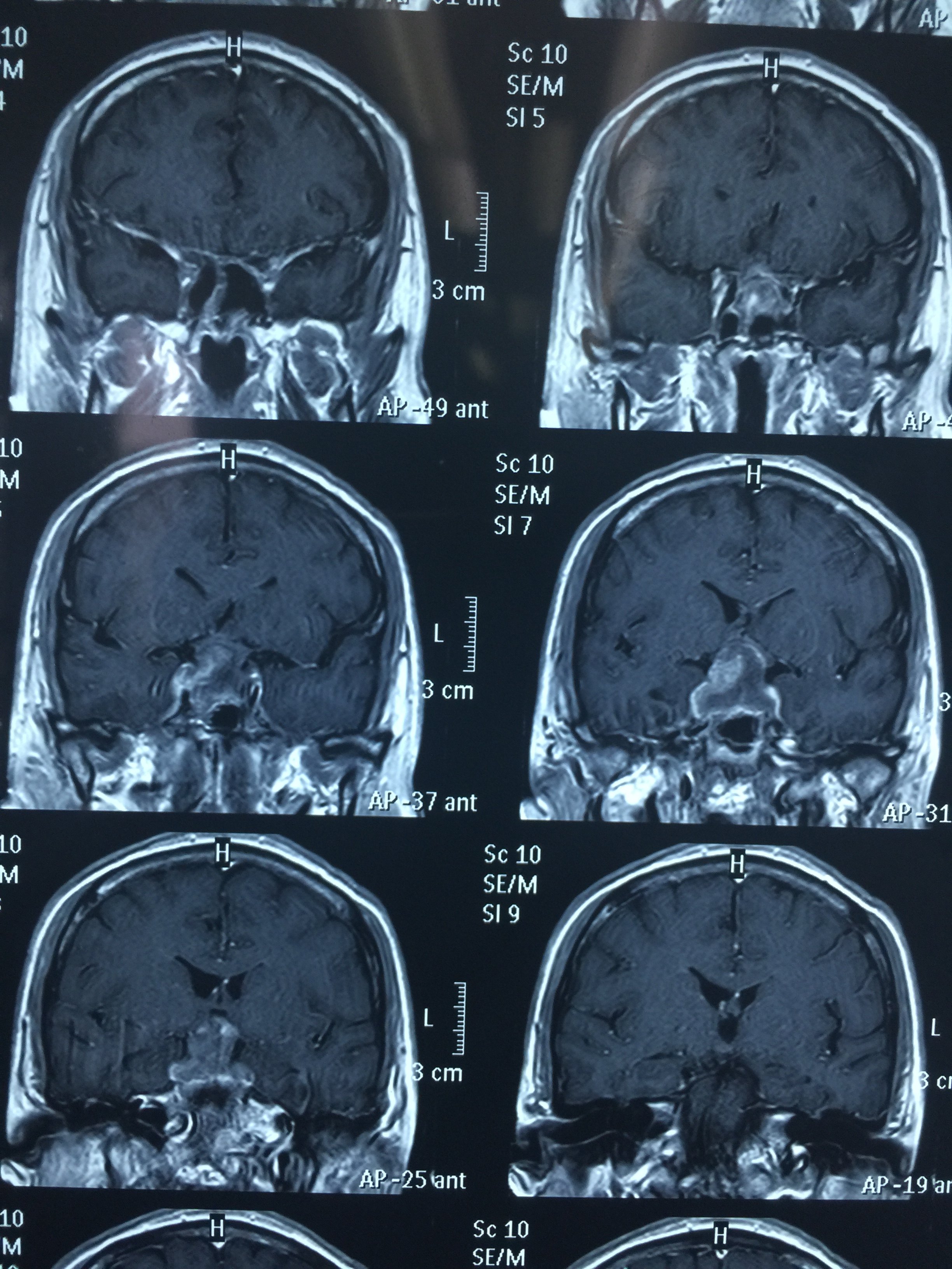 巨大垂体瘤经单鼻孔经蝶窦全切,术后视力恢复 